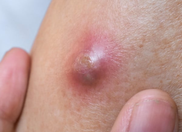 Boil on man's arm