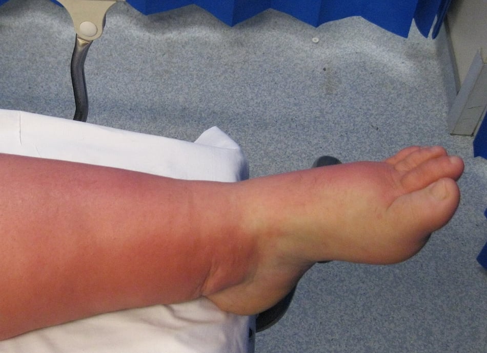 Cellulitis on lower leg 
