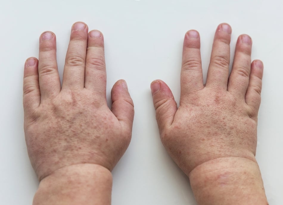 Child's hands with scarlet fever rash
