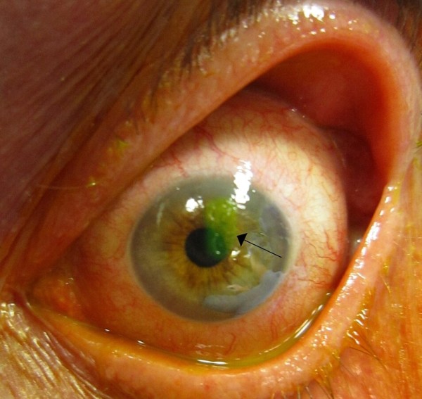 Arrow pointing to corneal abrasion on eye