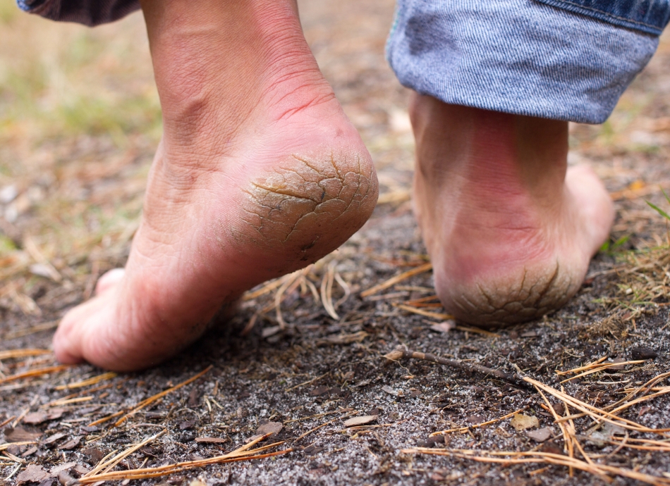 Cracked heels on feet