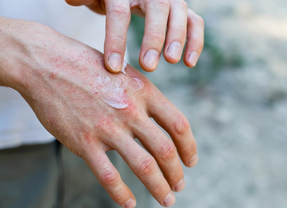 Cream being rubbed into irritated skin 