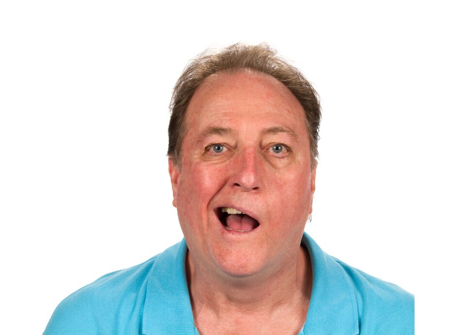 Man's face smiling one side not the other with Bells palsy 