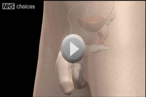 prostate enlargement computer image