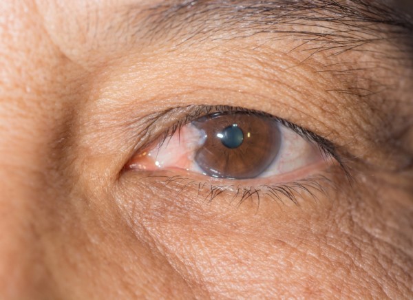 Photo of pterygium on inside corner of eye