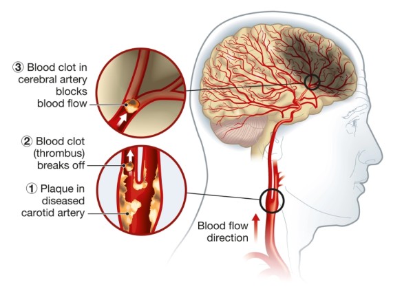 How a blood clot causes a stroke or TIA