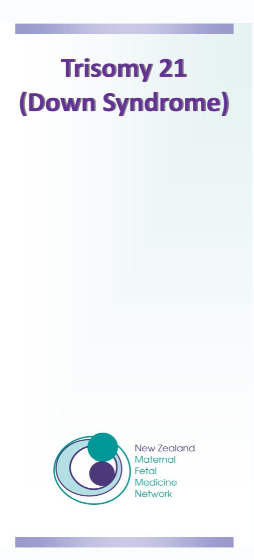 trisomy 21 down syndrome