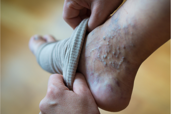 Person putting on compression stocking for varicose veins