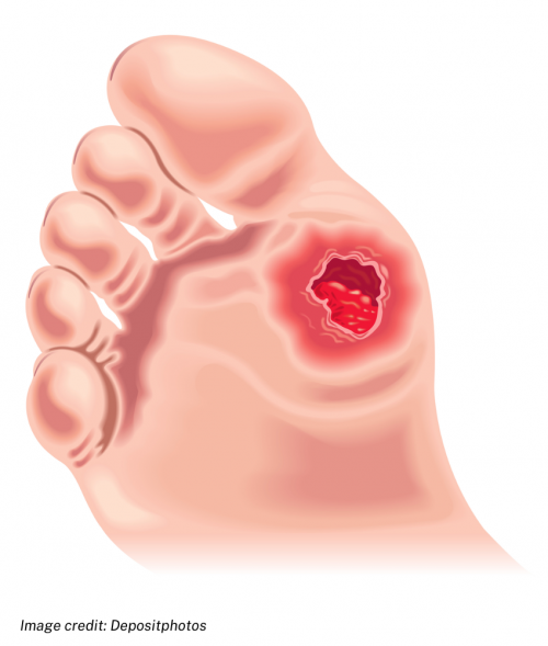 Sole of foot with diabetes-related foot ulcer