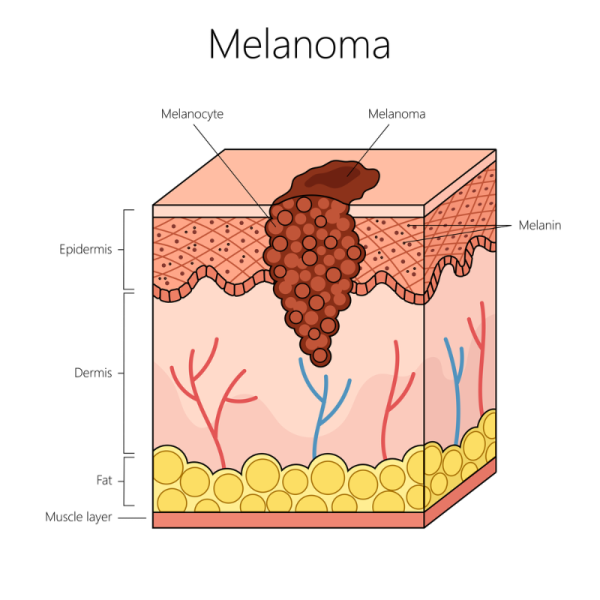 Cross-section of skin showing melanoma