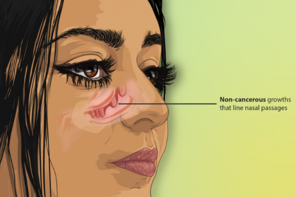 Image showing the location of nasal polyps