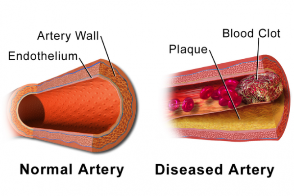 Normal and blocked artery