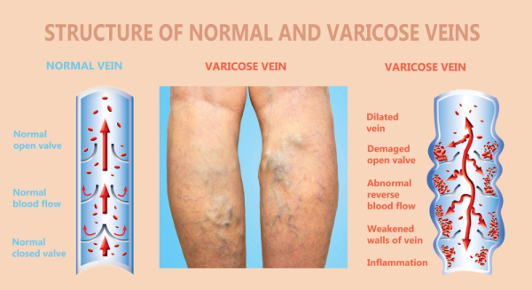 Blood flow in normal and varicose veins