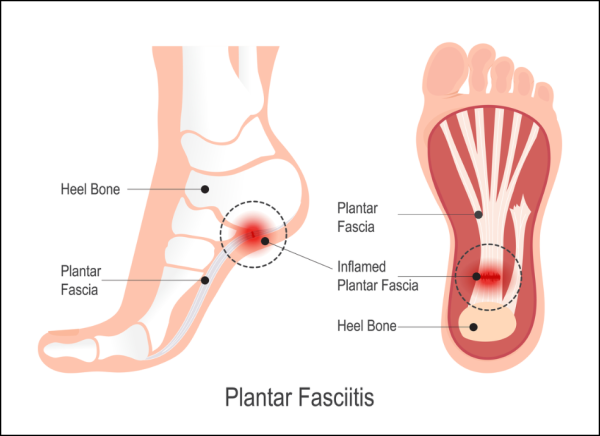 Image showing the location of the inflamed tissue associated with plantar fasciitis