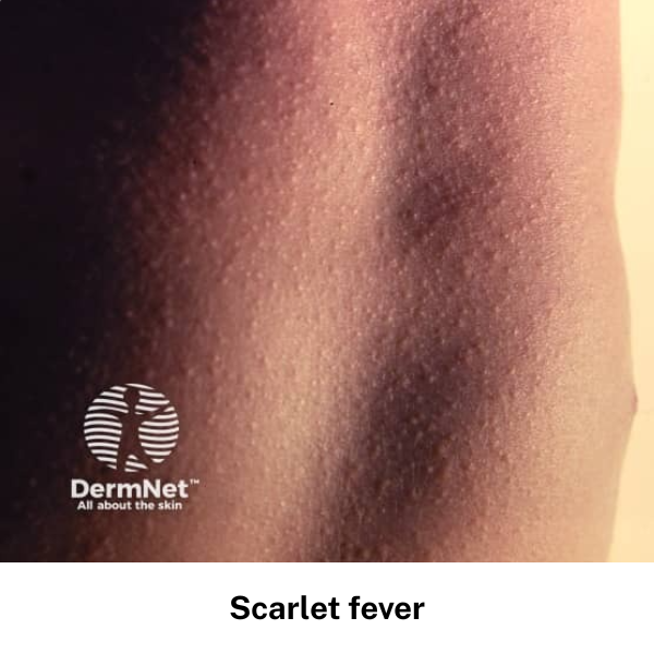 Scarlet fever rash on chest