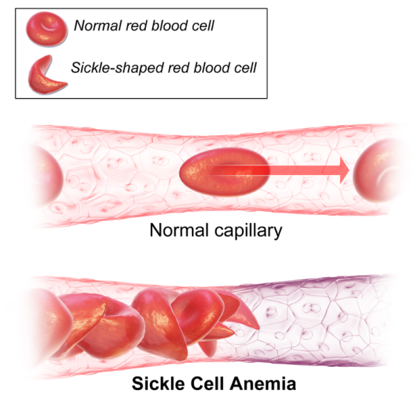 Normal and sickle cell red blood cells