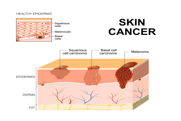 Graphic illustration of skin cancer layers on the epidermis 