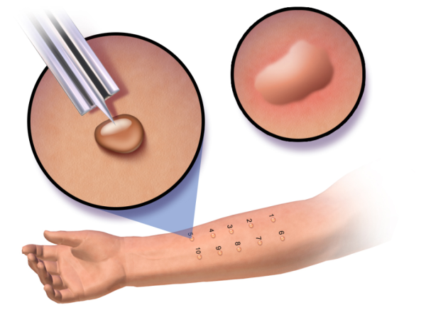 Skin prick test for allergen reaction