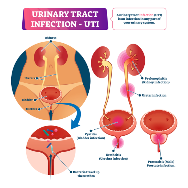 Urinary tract and where UTIs can occur