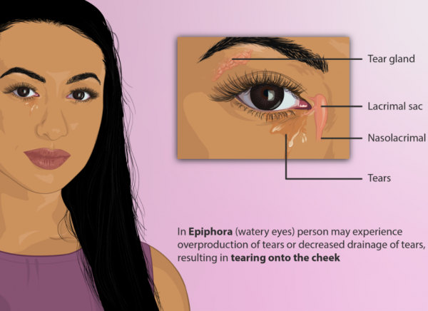 Image of eye showing how watery eye happens